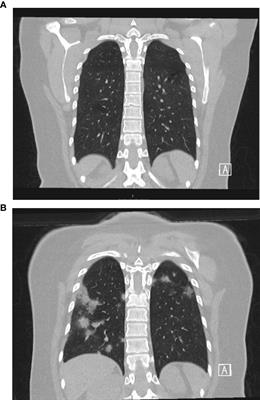 Case Report: Convalescent Plasma Achieves SARS-CoV-2 Viral Clearance in a Patient With Persistently High Viral Replication Over 8 Weeks Due to Severe Combined Immunodeficiency (SCID) and Graft Failure